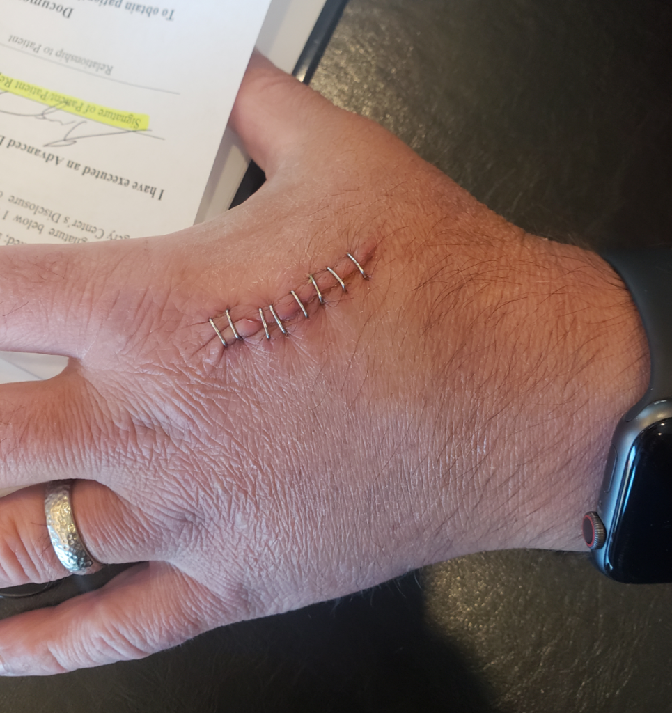 Hand with staples before surgery