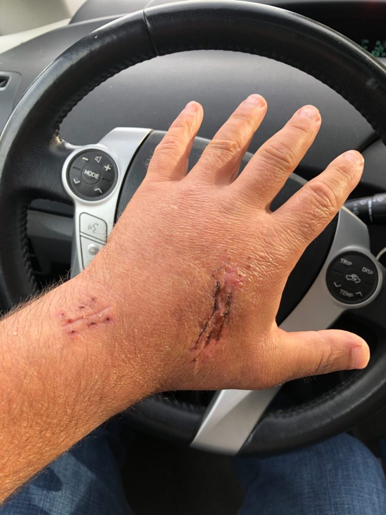 Hand after stitches removed